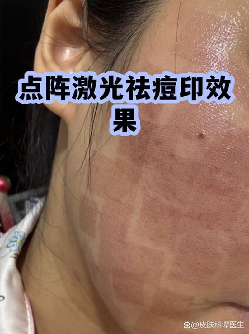 太原专业祛痘——青春与健康的对话
