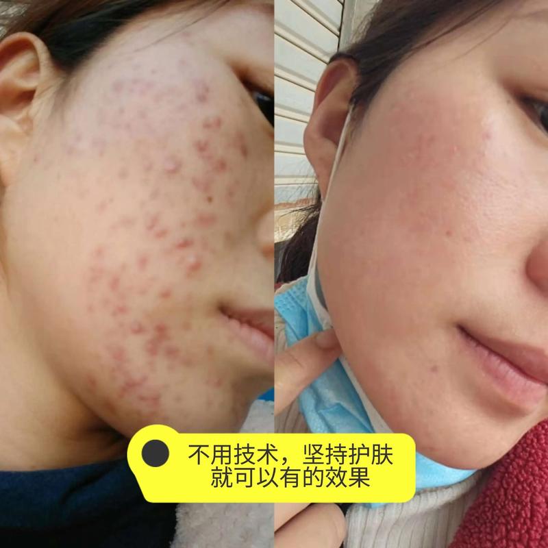 祛痘新趋势：从传统疗法到科技前沿