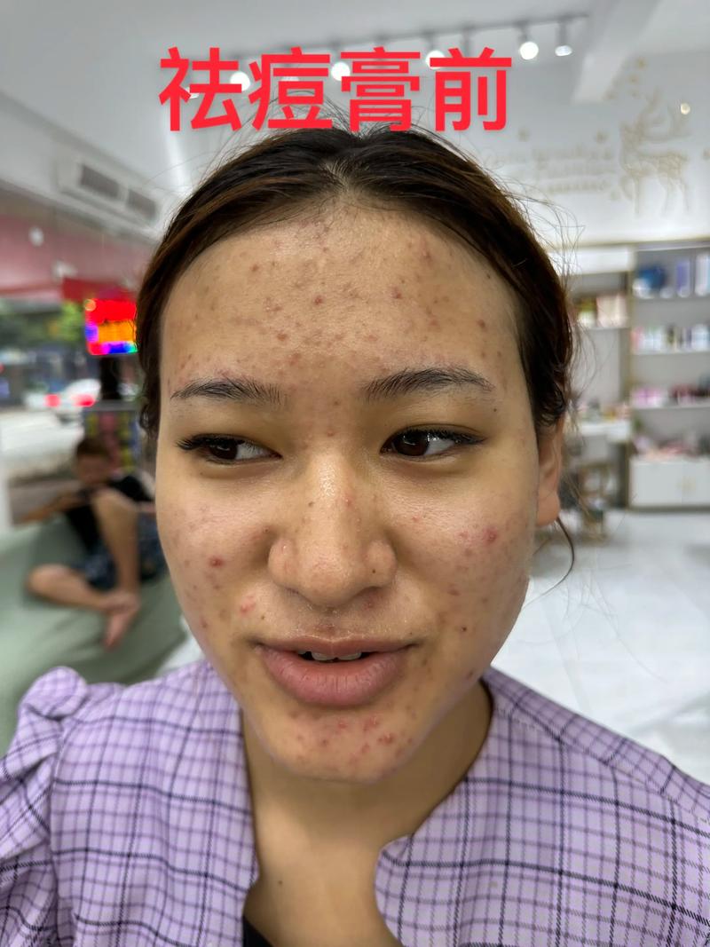太原祛痘哪里好？专业机构和医生推荐