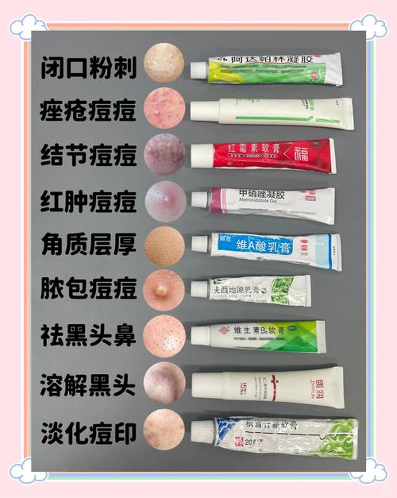 祛痘攻略：从根源入手，告别痘痘困扰